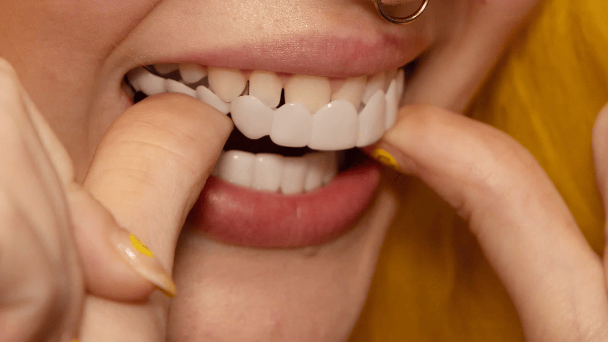 Snap-On Smile™ faner – Återanvändbara dental fasader för en strålande leende utan tandläkare